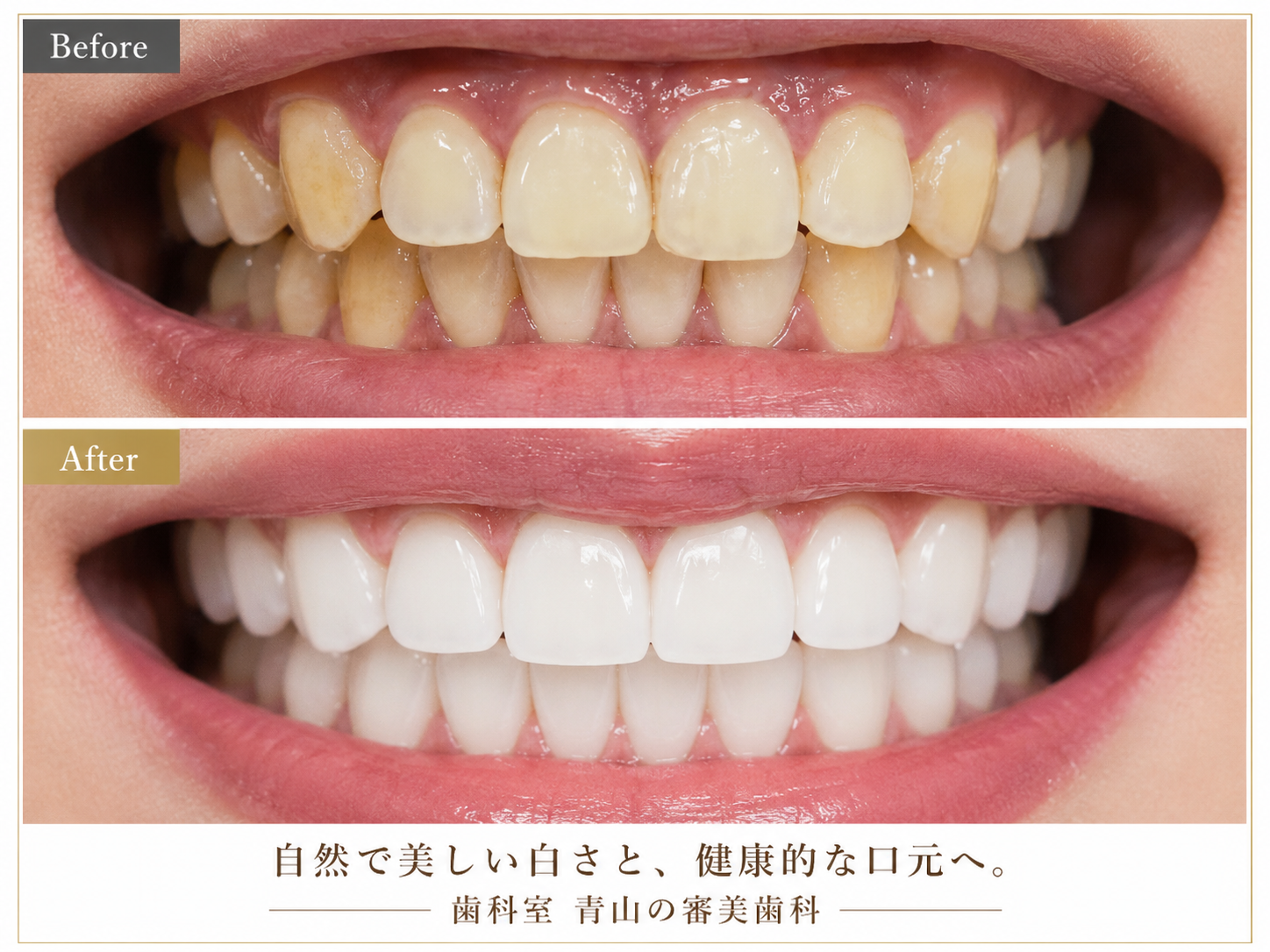 審美歯科のビフォー・アフターイメージ